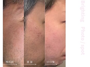 ドアディ(Doordie)/Brightingフォト　しみケア 