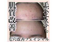 ルネッタ(Lunetta)の雰囲気（毛穴１つ１つを丁寧に確認し除去していく技術で毛穴も肌質も改善）