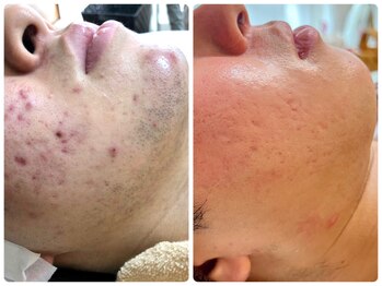 シシエル(CHICIEL)/ヒゲ脱毛で美肌に/メンズ脱毛