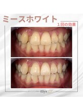 ミースホワイトニング(mys whitening)/ビフォーアフター【歯科提携】