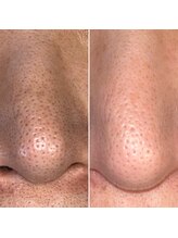 ウェヌ(VENE)/鼻の黒ずみは頑固、、、