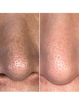 ウェヌ(VENE)/鼻の黒ずみは頑固、、、