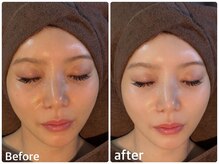 ボヌールデソワ(Bonheur de Soi)/ハーブピーリング/肌質改善