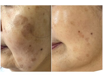 ハクビューティー(HAKU BEAUTY)/70代シミケア