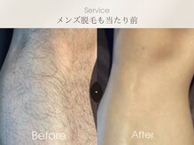 ベルダ(BELDAD)/【大流行！美肌脱毛！】