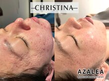 アザレア(Azalea)/CHRISTINAハーブピーリング¥8800