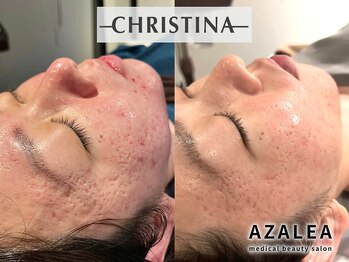 アザレア(Azalea)/CHRISTINAハーブピーリング¥8800