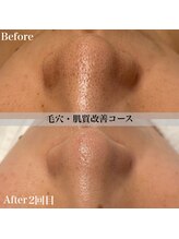 アール アンド ビューティーサロン(Ｒ＆ BeautySalon)/鼻のざらつきが消える！？