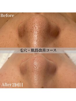 アール アンド ビューティーサロン(Ｒ＆ BeautySalon)/鼻のざらつきが消える！？