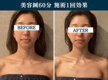 シンク(CINQ)/美容鍼灸60分むくみ/たるみケア