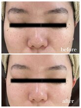 ジャスミン(Jasmin)/毛穴洗浄