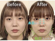 ラプリ 大宮店(Raplit)/隆鼻＋輪郭矯正40分10回