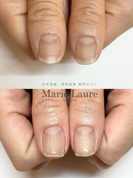 マリーロール 淀屋橋本店(Marie Laure)/自爪育成/深爪矯正/ネイルケア