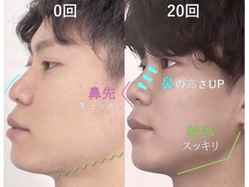 ラプリ 大宮店(Raplit)/隆鼻＋輪郭矯正40分30回