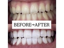 ホワイトニングサロン 宝塚/Before&After美白ホワイトニング