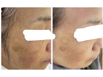 ウェヌ(VENE)/シミ＆くすみケアは定期的必須！