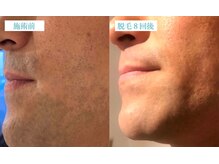 マリーボーテ 名古屋店/【ヒゲ脱毛８回】青髭もお任せ♪