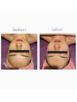 ライゼ(REISE)/ビフォーアフター【美白/小顔】