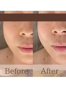 凪眠/小顔リンパフェイシャルの効果4