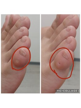 遊歩堂/小指上魚の目