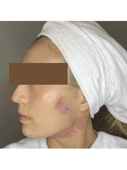 ヘラ(HERA)の写真/【二重顎・口横の脂肪のお悩みに】インモードリフト半顔（顎下～口横～エラ）