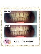 パーチポーチ(PERCH PORCH)/照射４回目