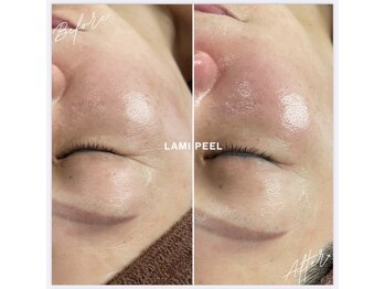 リラクゼーションアンドビューティーボヌール(BONHENR)/ラミネーションピールの効果