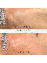 ルルマル(lulumalu)/光フェイシャル