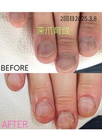 噛み爪深爪育成