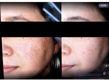 アンド(and...)/肌質改善・フェイスワックス