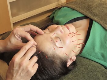 モカ(MOKA)の写真/国家資格者が施す本格美容鍼で年齢肌と小顔、たるみ改善などのお悩みに徹底対応