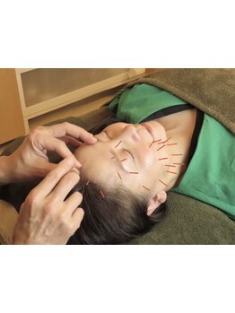 鍼灸施術を受けたい