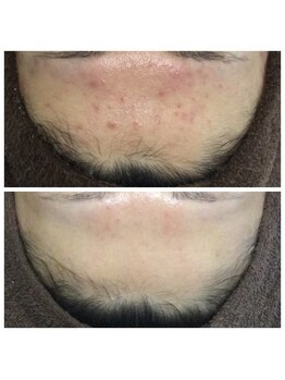 リラーナ(Re rana)/大人ニキビケア