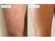 マリーボーテ 名古屋店/【足脱毛２回】夏までにツルツル
