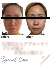 リノン(LIINON)/たるみの原因は肩こりだった？！