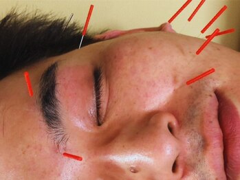 シフク鍼灸整体院の写真/おじさんだってキレイでいたい!心身の不調が!疲れが!実年齢よりも老けた印象に!美容鍼+整体で解決♪