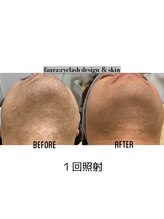 ファウラ(faura:)/【メンズ】ヒゲ脱毛