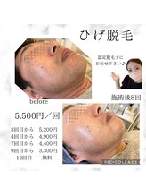 リシア(Re.sia)/メンズ髭脱毛8回後