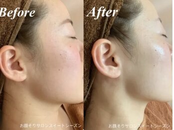 ブリス(bliss)/ブライダルシェービング♪