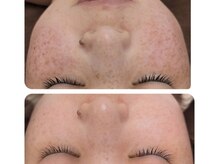 リノ沼津(Lino)/ハーブピーリングで改善