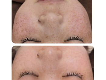 リノ沼津(Lino)/ハーブピーリングで改善