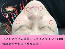 健美庵/リフトアップ・引き上げに美容鍼