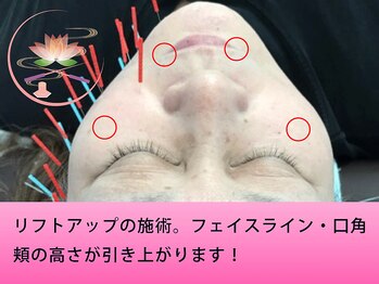 健美庵/リフトアップ・引き上げに美容鍼