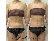 ソルヴィス(SOLVIS)/