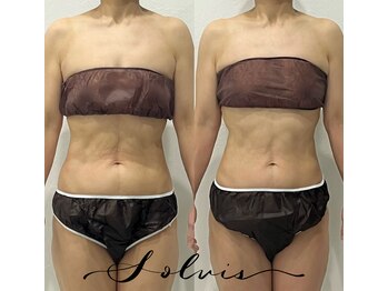 ソルヴィス(SOLVIS)/