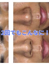 スパッツィオ(spazio)/【セラピール&フォト美顔2回目】