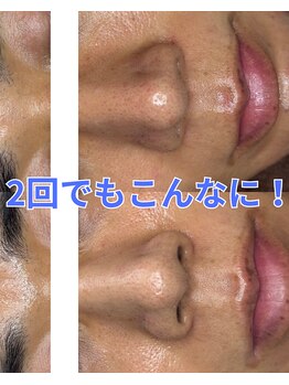 スパッツィオ(spazio)/【セラピール&フォト美顔2回目】