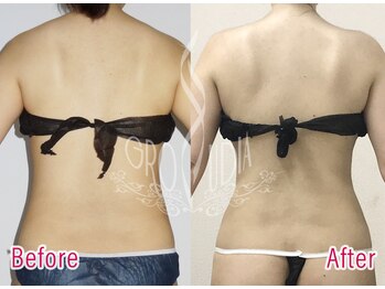 グラウディア 恵比寿/痩身/筋膜リリース/インディバ超