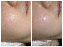 ひぺりかむ/【韓国水光肌】短時間で☆ご来店