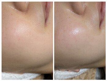 ひぺりかむ/【韓国水光肌】短時間で☆ご来店